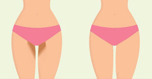 6 Causes of Dark Inner Thigh & How To Lighten Them?