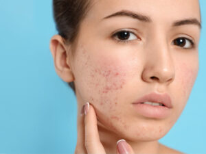 scar acne skin care