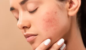 sensitive acne prone 