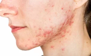 Acne nodules and cysts