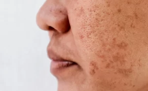 Blackheads (dark spots) and pimples
