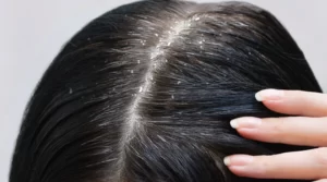 dandruff-and-greying-of-hair