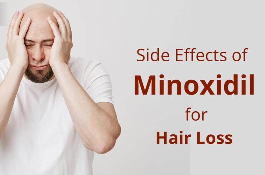 10 HARMFUL EFFECTS OF MINOXIDIL TOPICAL SOLUTION THAT ARE WORTH KNOWING